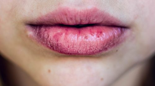 levres-gonflees-causes-solutions