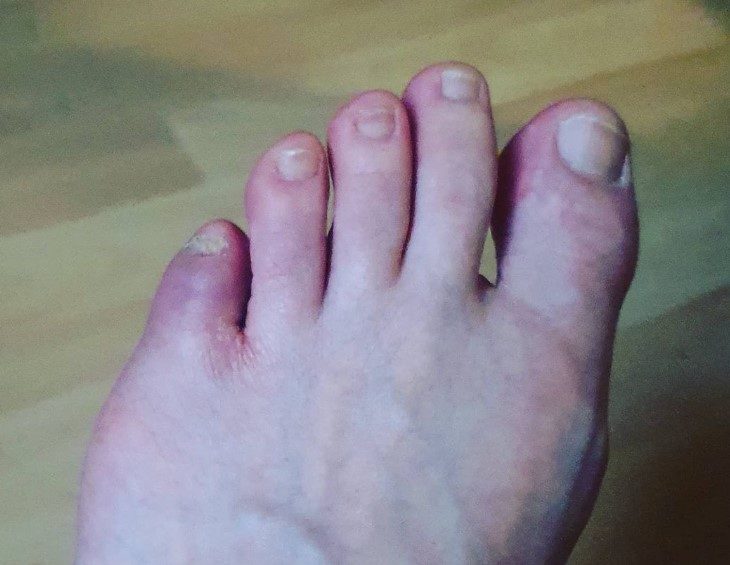 orteil casse inflammation