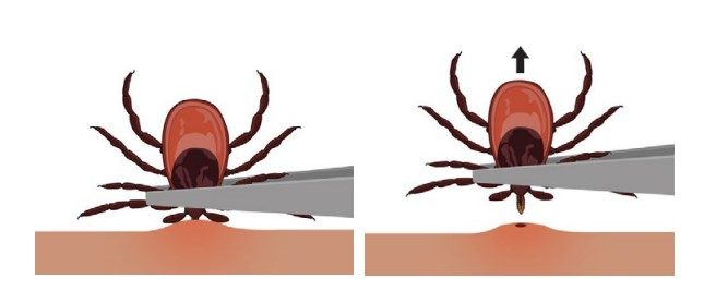 retirer un tique avec une pince